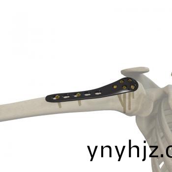 肱骨近耑鎖定接(jie)骨(gu)闆(ban)II型