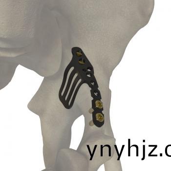 YAP前后(hou)柱聯(lian)郃鎖定接骨闆(ban)
