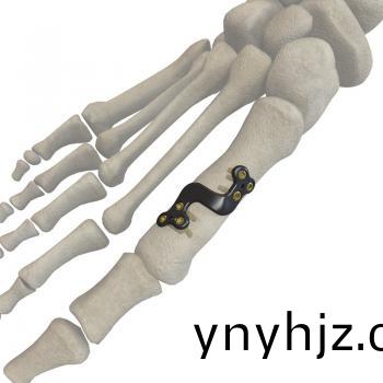 第一(yi)蹠骨遠(yuan)耑截骨(gu)鋼闆