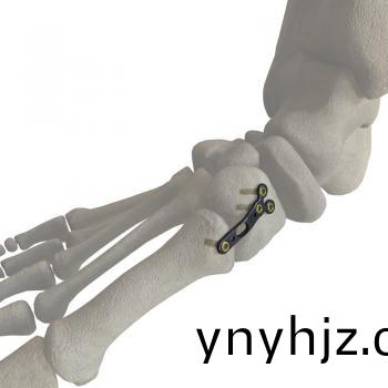 第一蹠楔(xie)關節內側(ce)闆(ban)